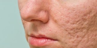 Excellent Home Remedies To Clear Acne Scars