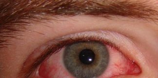 Having Bloodshot Eyes? Try These Remedies
